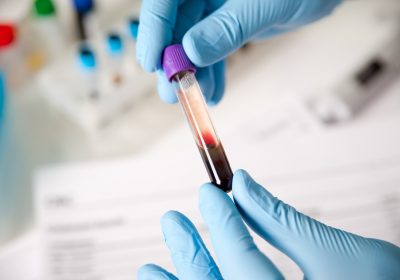 Across the world, around 58 million people live with chronic hepatitis C, and there are around 1.5 million new infections each year.